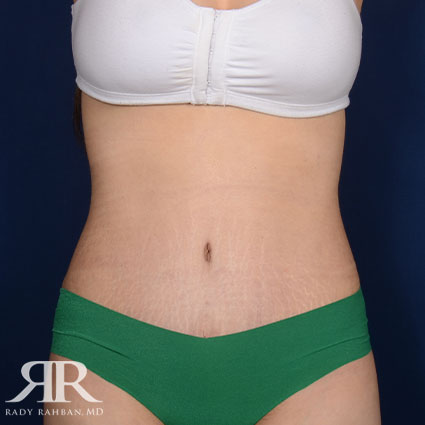 Tummy Tuck