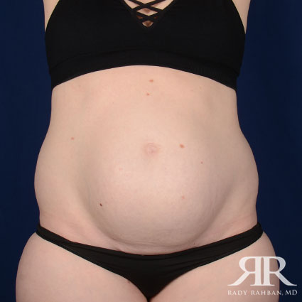 Tummy Tuck