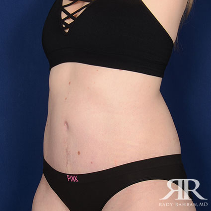 Tummy Tuck