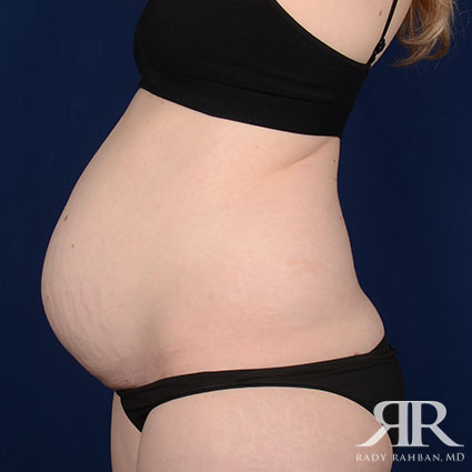 Tummy Tuck