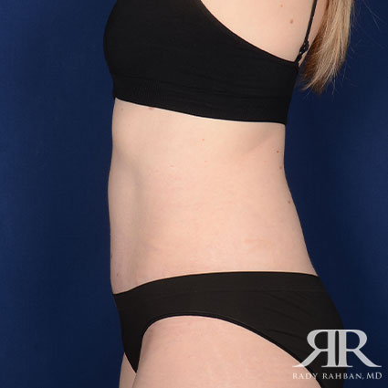 Tummy Tuck