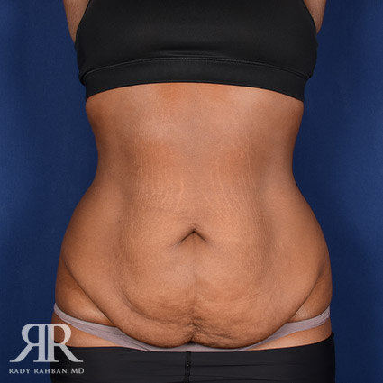 Tummy Tuck