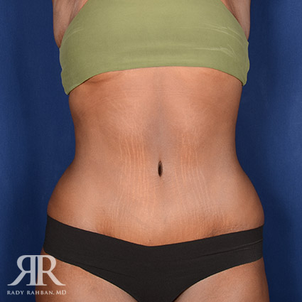 Tummy Tuck