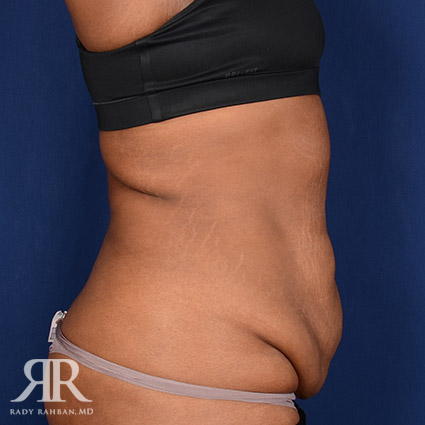 Tummy Tuck