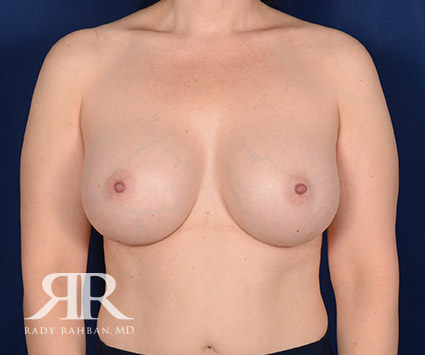 Breast Augmentation