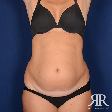 Severe Diastasis Recti