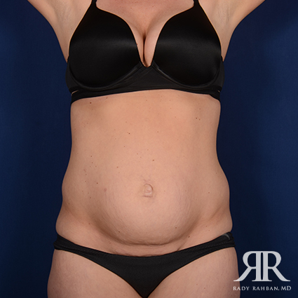 Tummy Tuck