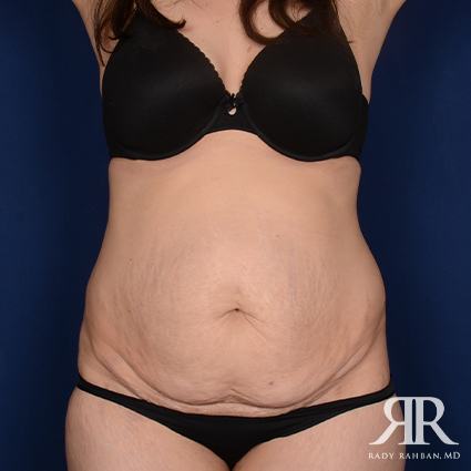 Severe Diastasis Recti