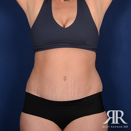 Tummy Tuck