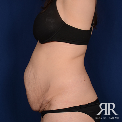 Severe Diastasis Recti