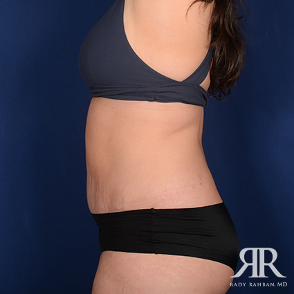 Severe Diastasis Recti