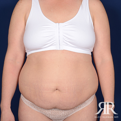 Tummy Tuck