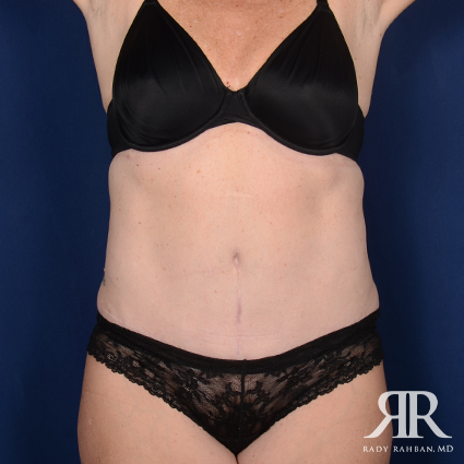 Tummy Tuck