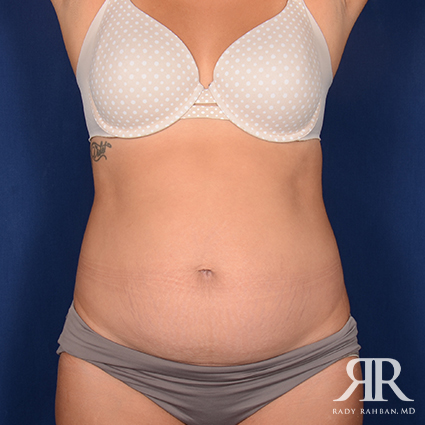 Tummy Tuck