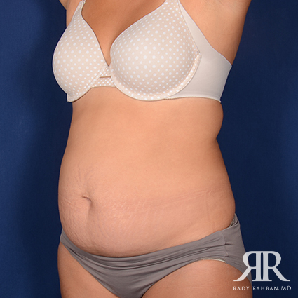 Tummy Tuck