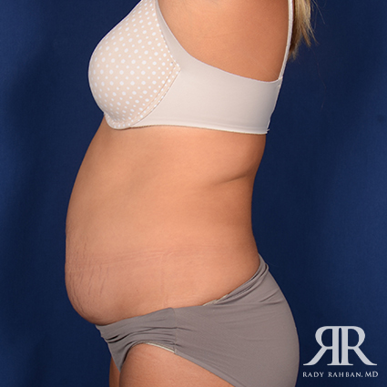 Tummy Tuck