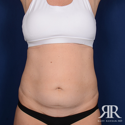 Tummy Tuck