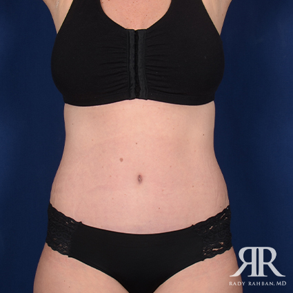 Tummy Tuck