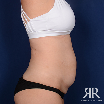 Tummy Tuck