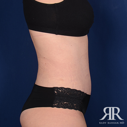 Tummy Tuck