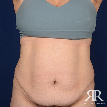 Tummy Tuck