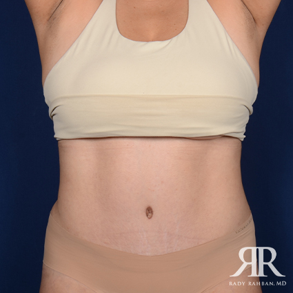 Tummy Tuck