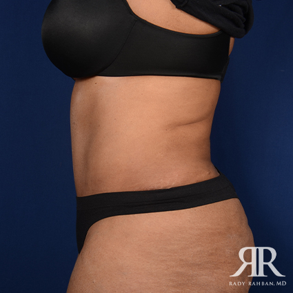 Tummy Tuck