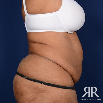 Tummy Tuck