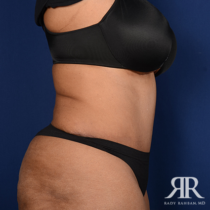 Tummy Tuck