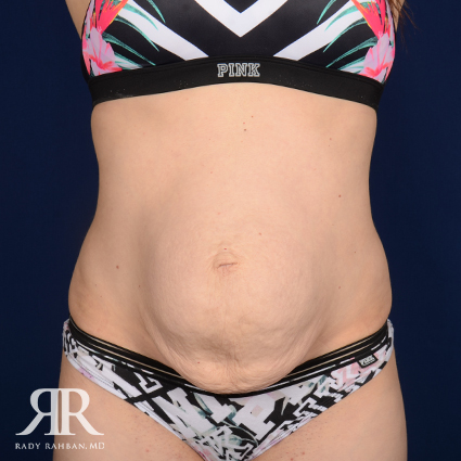 Tummy Tuck