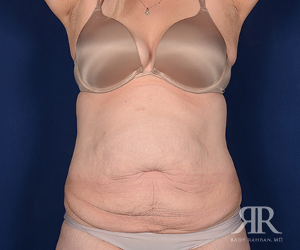 Tummy Tuck