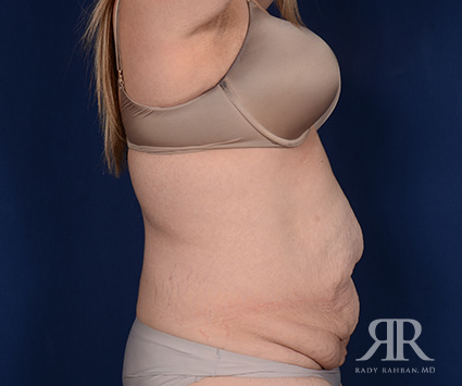 Tummy Tuck