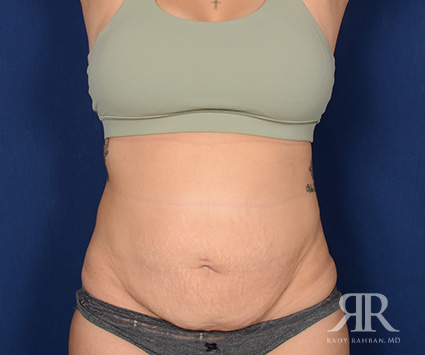 Tummy Tuck