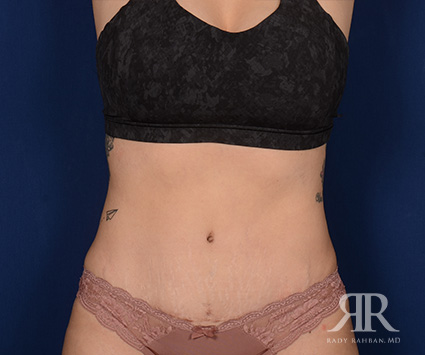 Tummy Tuck