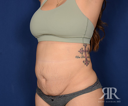 Tummy Tuck