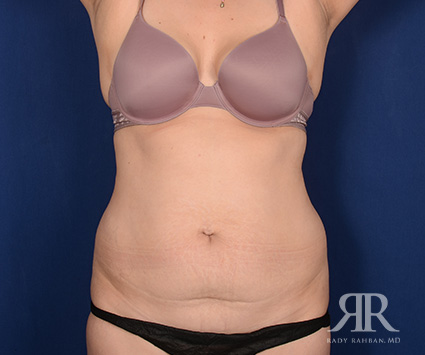 Tummy Tuck