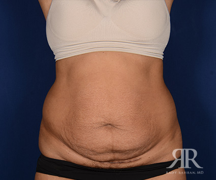 Tummy Tuck