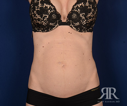 Tummy Tuck