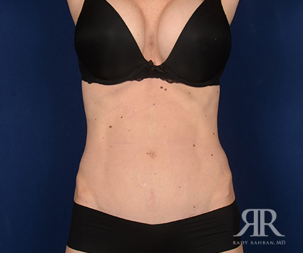 Tummy Tuck