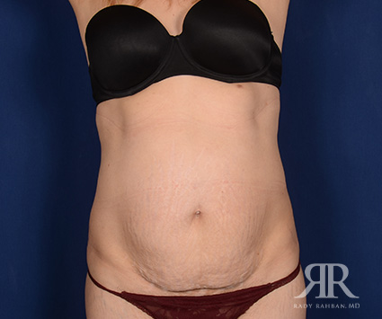 Tummy Tuck