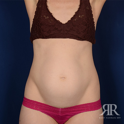 Severe Diastasis Recti