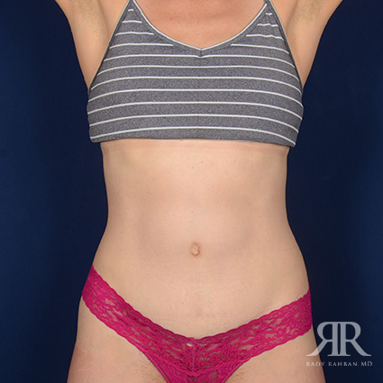 Severe Diastasis Recti