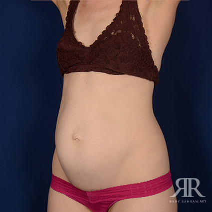 Severe Diastasis Recti