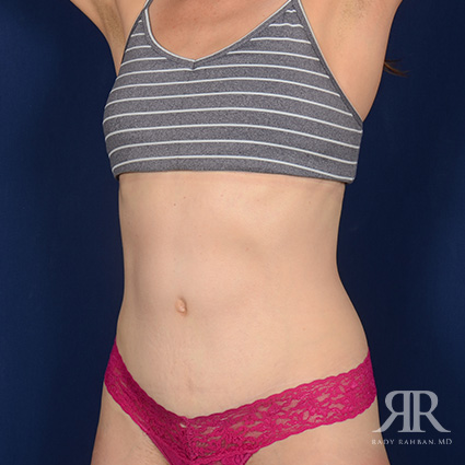 Tummy Tuck