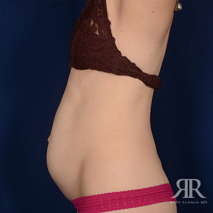 Tummy Tuck