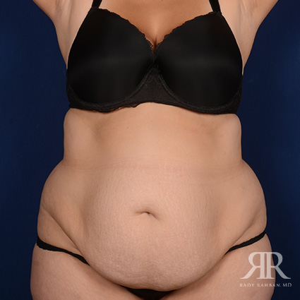 Tummy Tuck