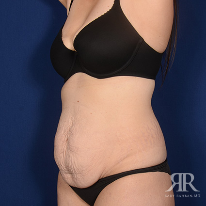 Tummy Tuck