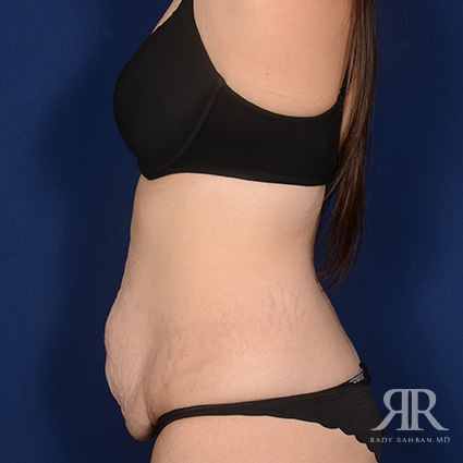 Tummy Tuck