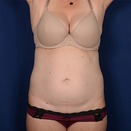 Tummy Tuck