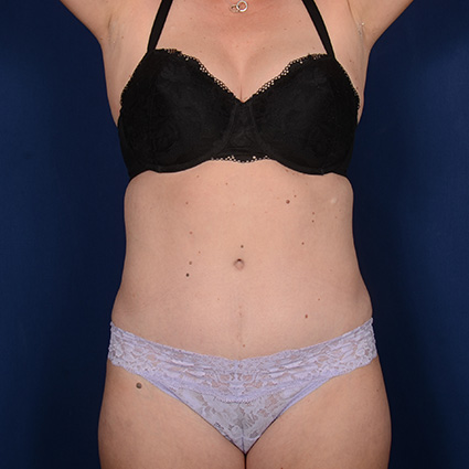 Tummy Tuck